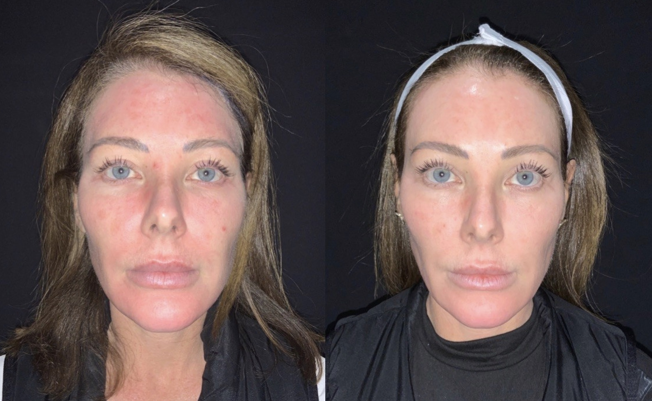 The Sciton Moxi Laser Revolutionizing Skin Rejuvenation And Who Stands