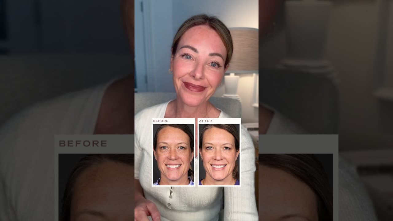 Video thumbnail: First-Time Filler + Daxxify in Her 40s | Natural Before & After