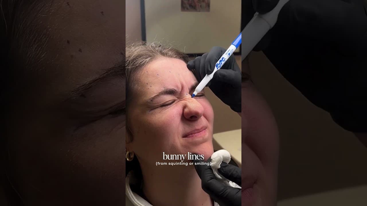 Video thumbnail: Botox facial mapping: why every face gets a custom plan