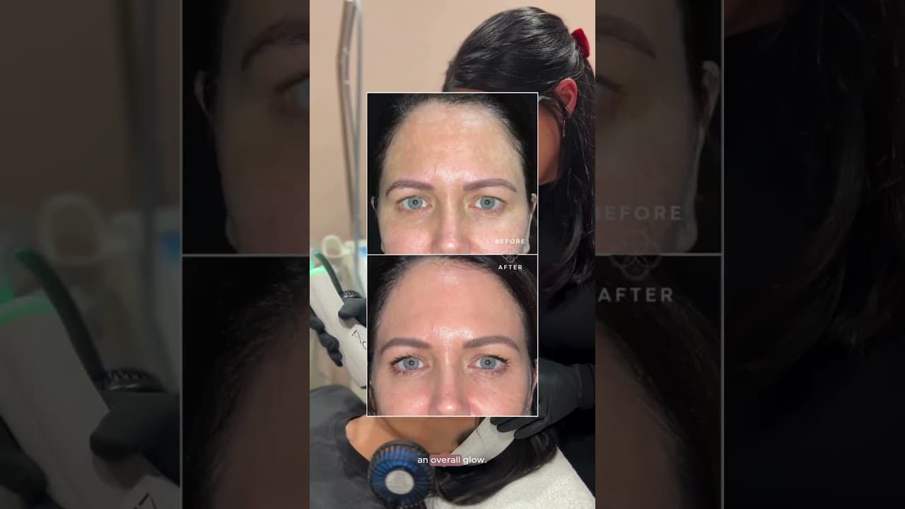 Video thumbnail: Sun damage treatments explained: BBL, MOXI, and UltraClear