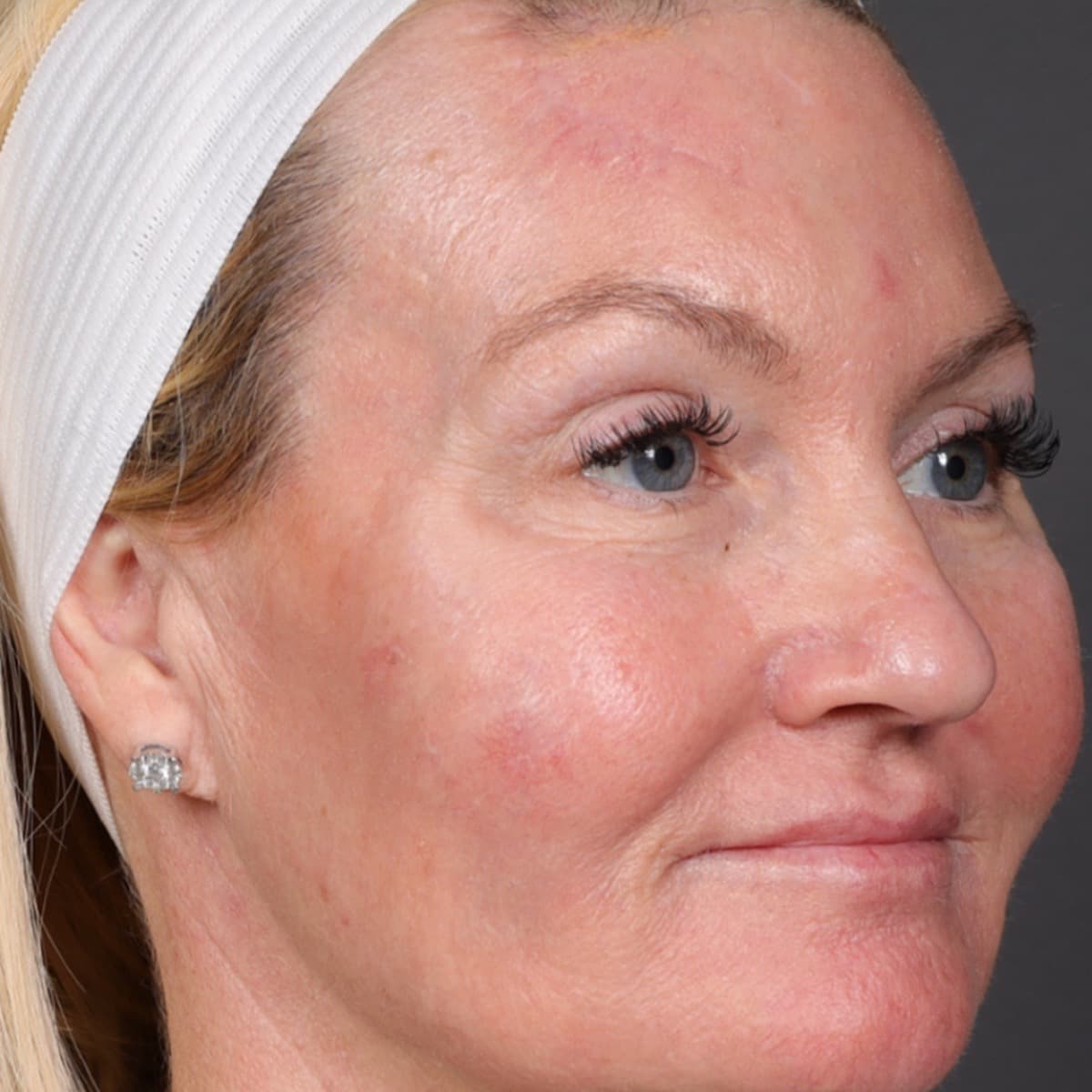 The same patient's cheek, noticeably smoother, after five years of conservative treatment at The Look Aesthetics