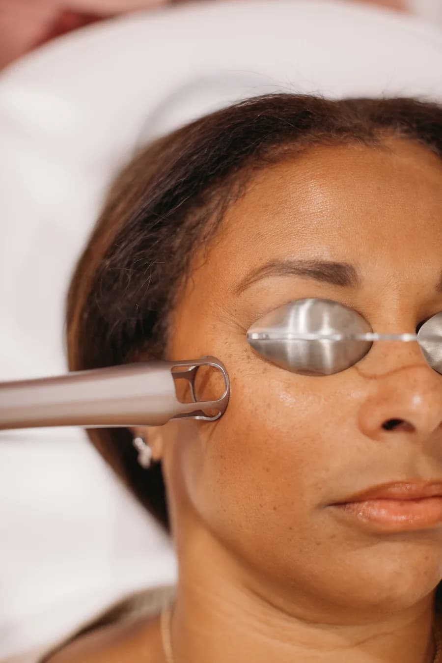 A laser treatment being performed at The Look Aesthetics