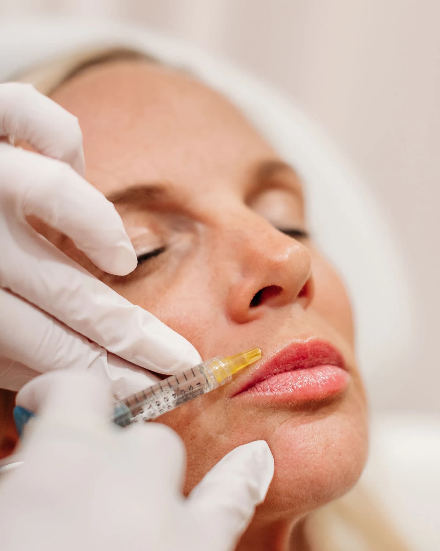 Filler treatment at The Look Aesthetics