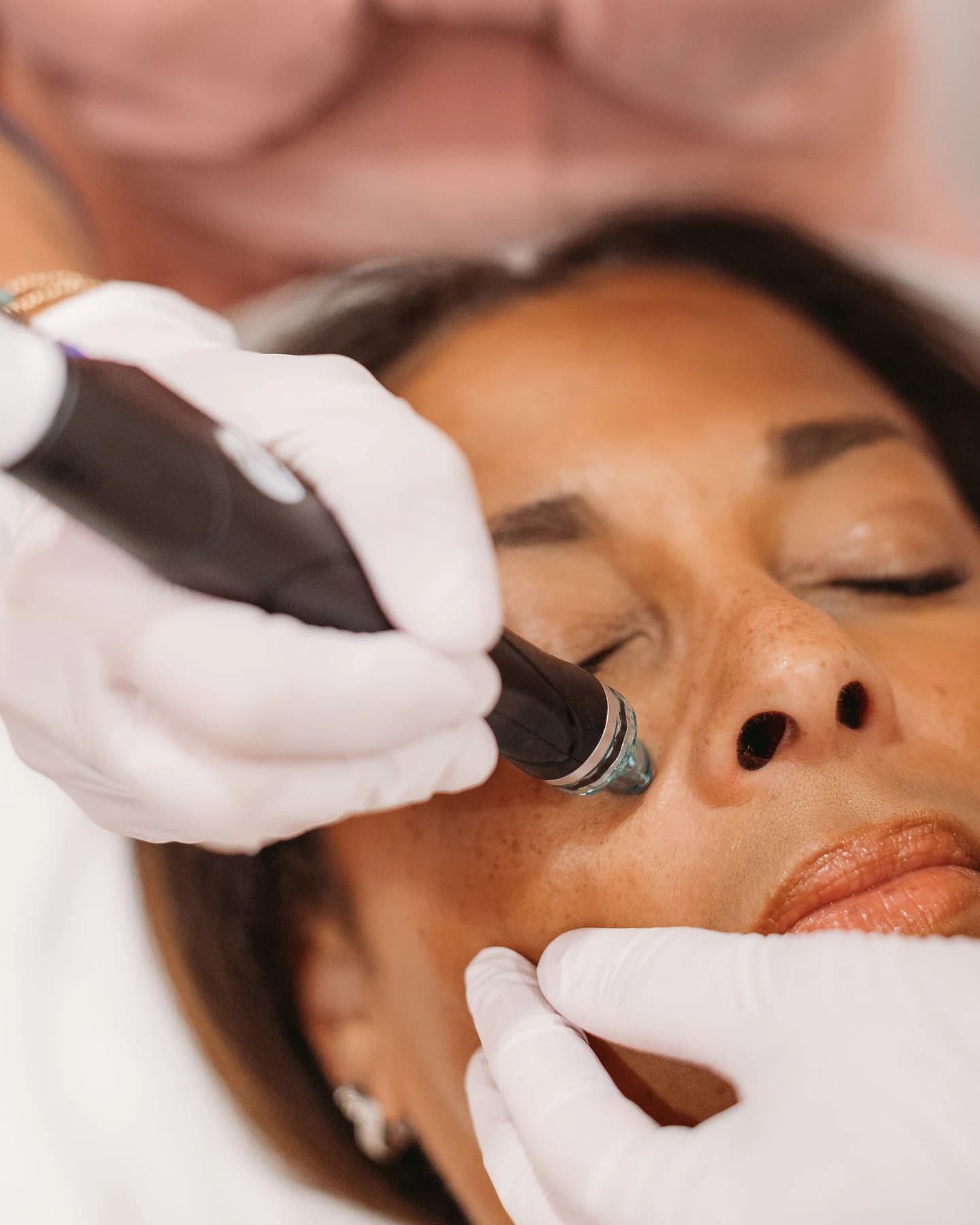 HydraFacial treatment at The Look Aesthetics