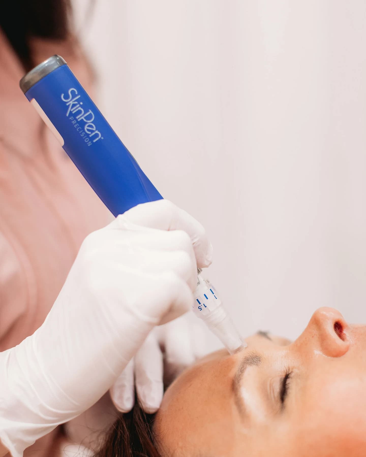 SkinPen treatment at The Look Aesthetics