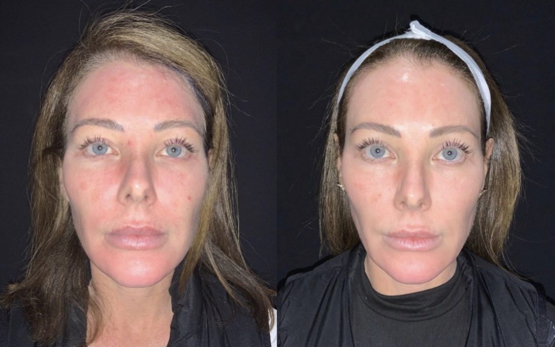The Sciton Moxi Laser: Revolutionizing Skin Rejuvenation and Who Stands to Benefit
