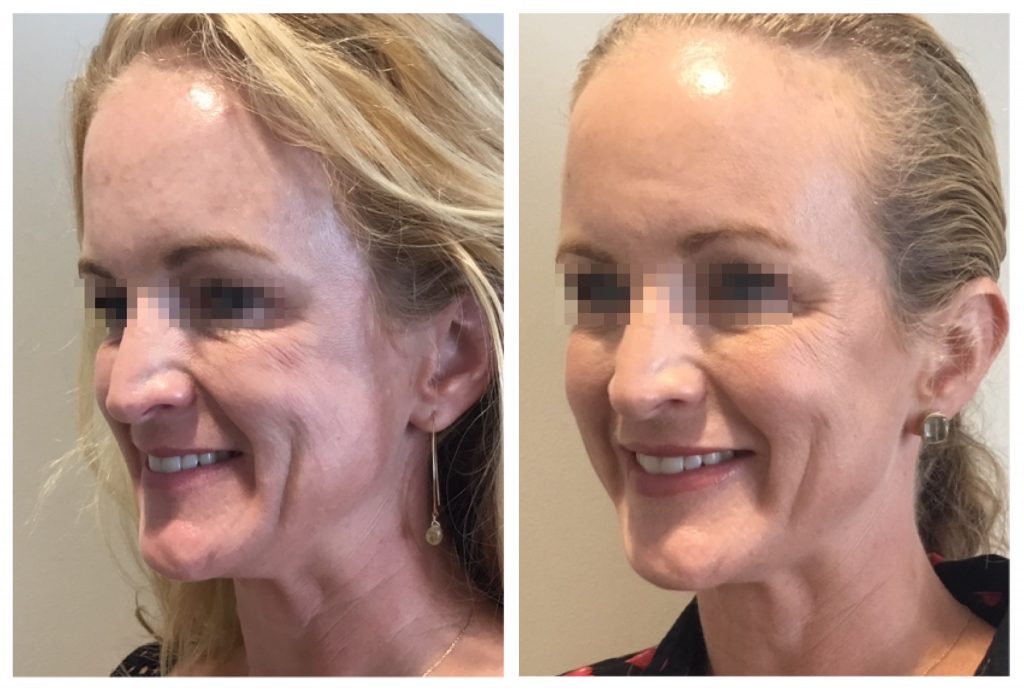 Mid face cheek volume and Botox in upper face