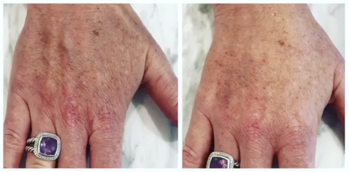 hand rejuvenation at the look before and after