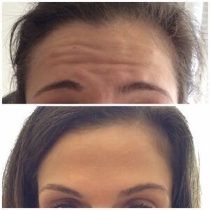 haley the look botox before and after