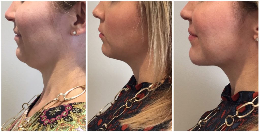 Kybella Before and After