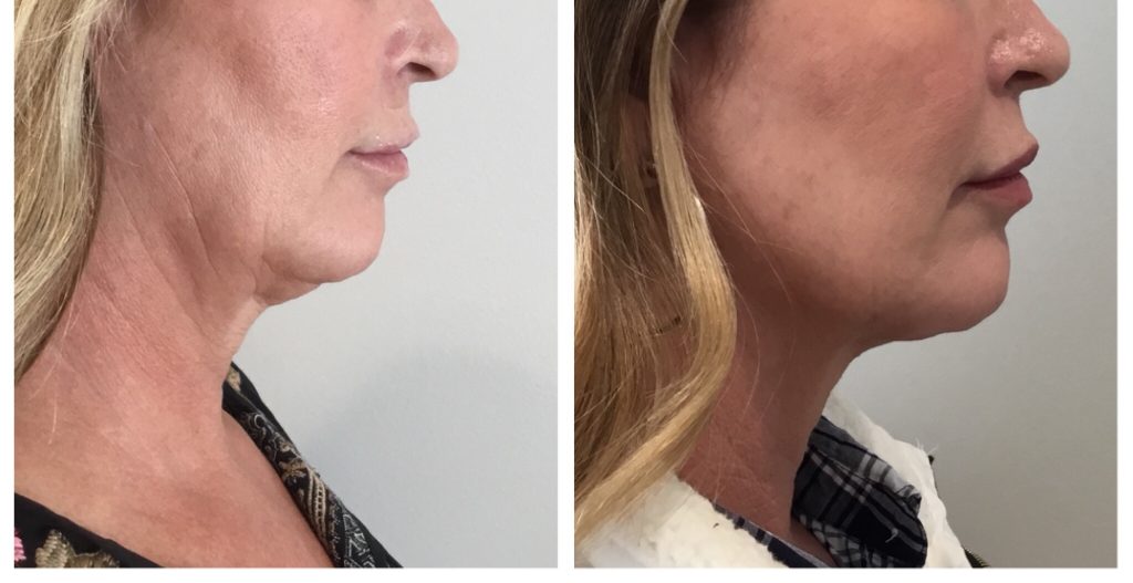 kybella before and after