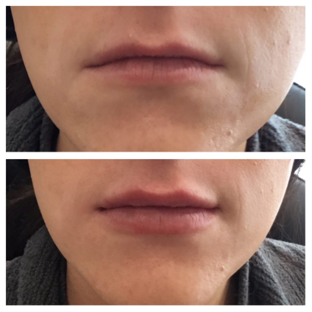 lips with dermal fillers